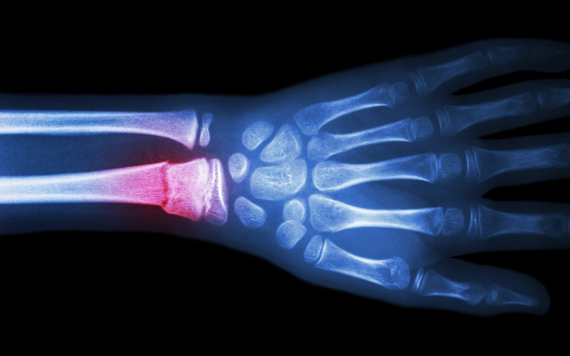 A Promising New Strategy To Help Broken Bones Heal Faster Penn Today